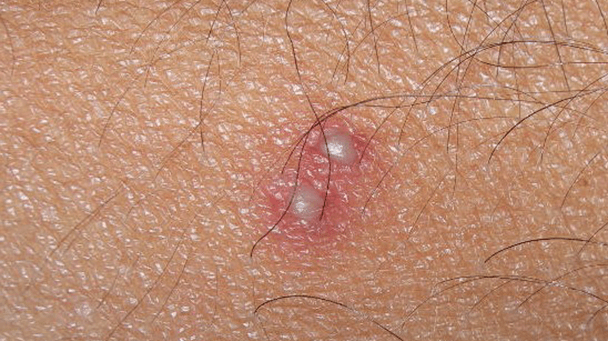 Pest And Disease Center Powdery Red Imported Fire Ant Sideimage2 608X341